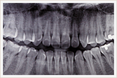 噛み合わせ治療